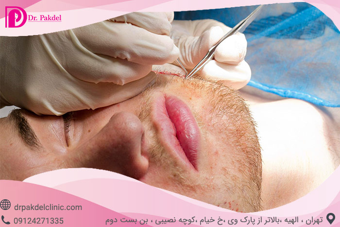 کاشت ریش چگونه انجام می شود؟
