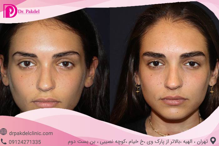 کاشت ابرو طبیعی چیست و چگونه انجام می شود؟