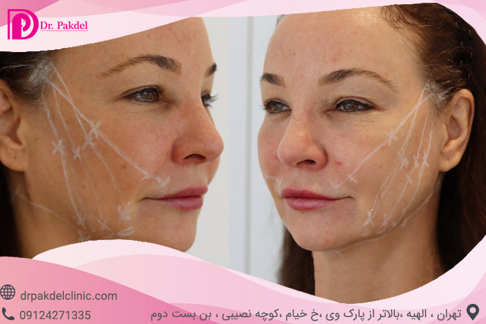 لیفت صورت face lift چیست؟