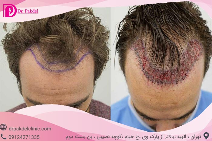کاشت مو چگونه انجام می شود؟ انواع روش ها,عوارض
