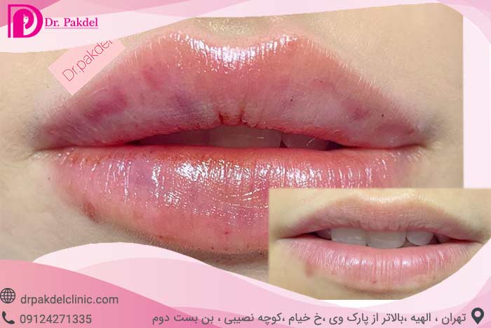 تزریق ژل لب | قیمت و معرفی انواع ژل