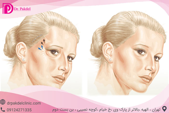 لیفت شقیقه چگونه انجام می شود؟